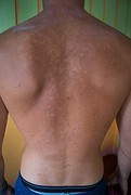 Peeling skin
