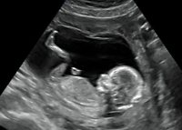 63. Baby echo