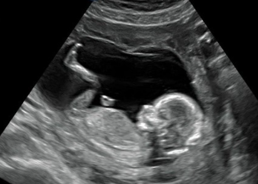 63. Baby echo