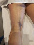 Bont en blauw been op de massagetafel