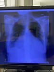 Post partum cardiomyopathie