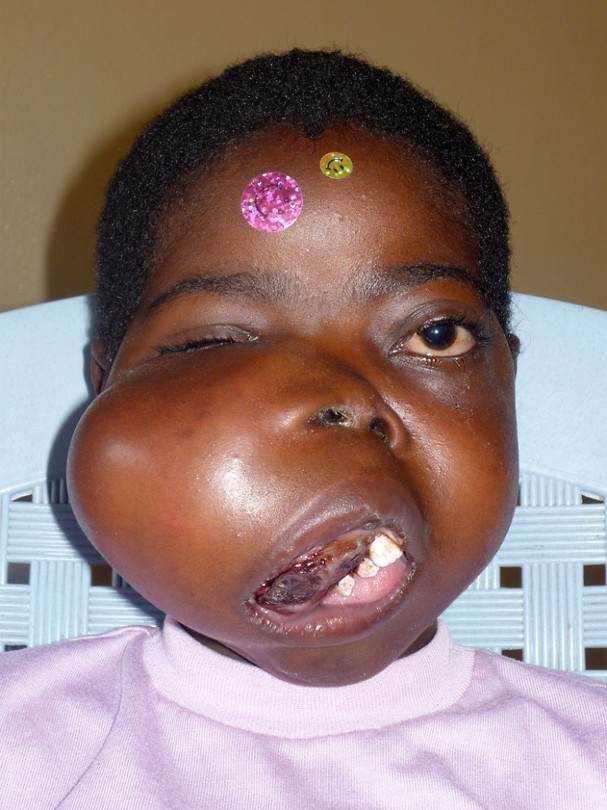 burkittlymfoma