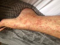 Midges result
