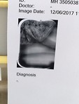 Röntgenfoto waarop achtergebleven wortelrest zichtbaar is
