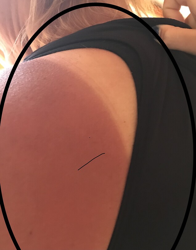 Een beetje verbrand 🥵