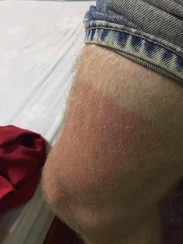 Burnt
