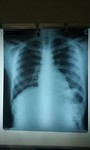 X-thorax