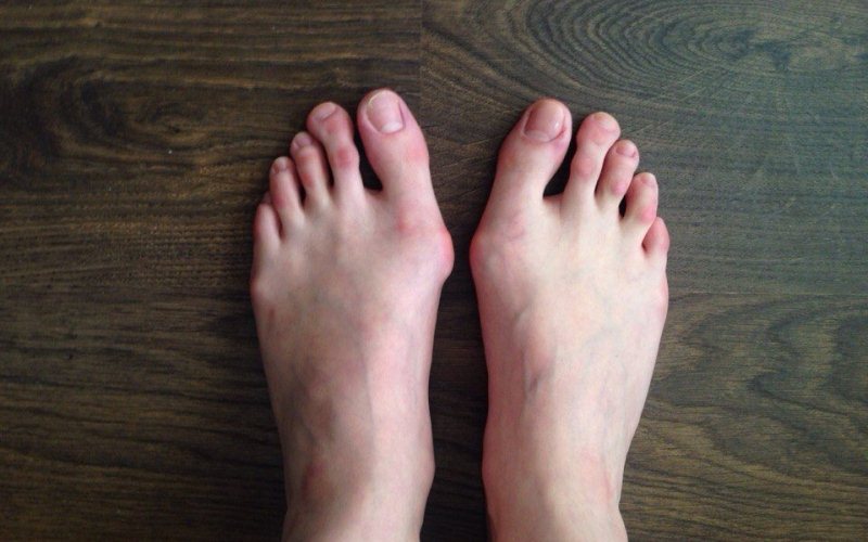 How to Fix a Bunion Without Surgery (4 Easy Tips)
