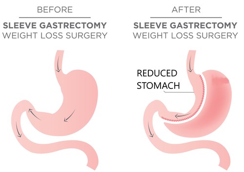 Bmi For Bariatric Surgery