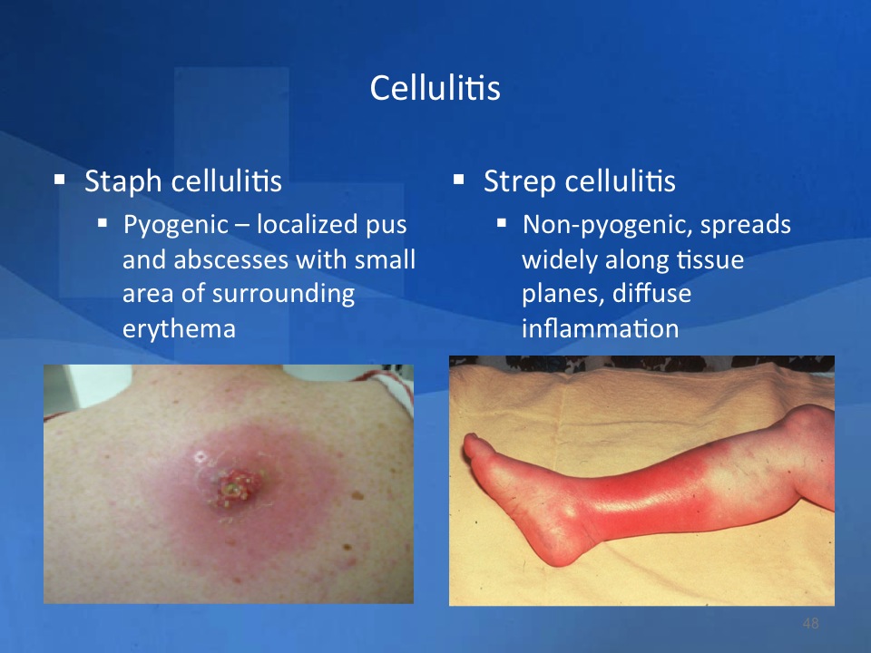 Strep Infection What Causes It At Nate Hocking Blog