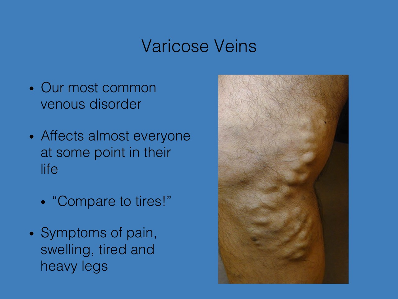 varicose bruise pe ires varicoză de coafură