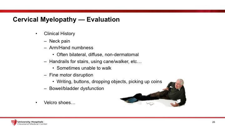 Cervical Radiculopathy Myelopathy University Hospitals