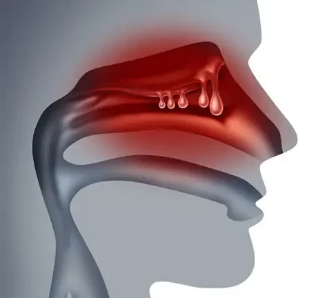 Understanding Sinus Infections