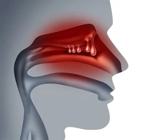 Understanding Sinus Infections