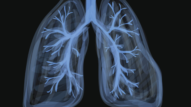 Shocking Dangers of EVALI: How Vaping is Silently Wrecking Your Lungs
