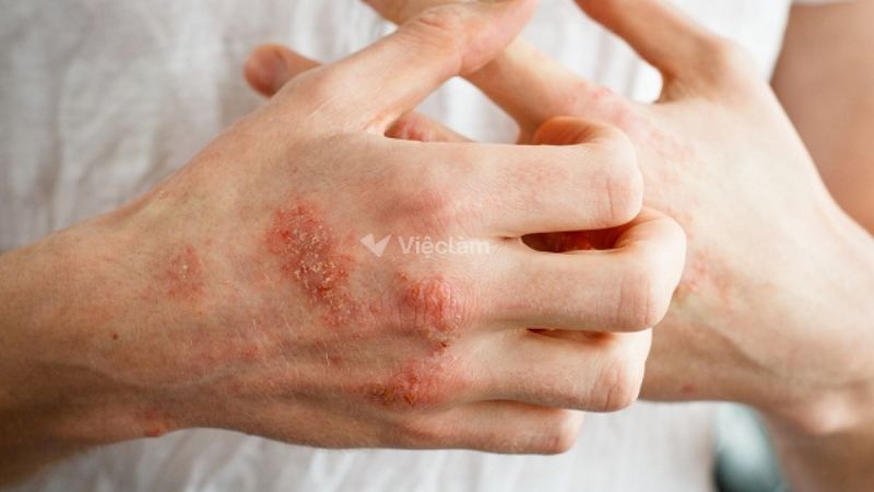 Da bị kích ứng do tiếp xúc với hóa chất