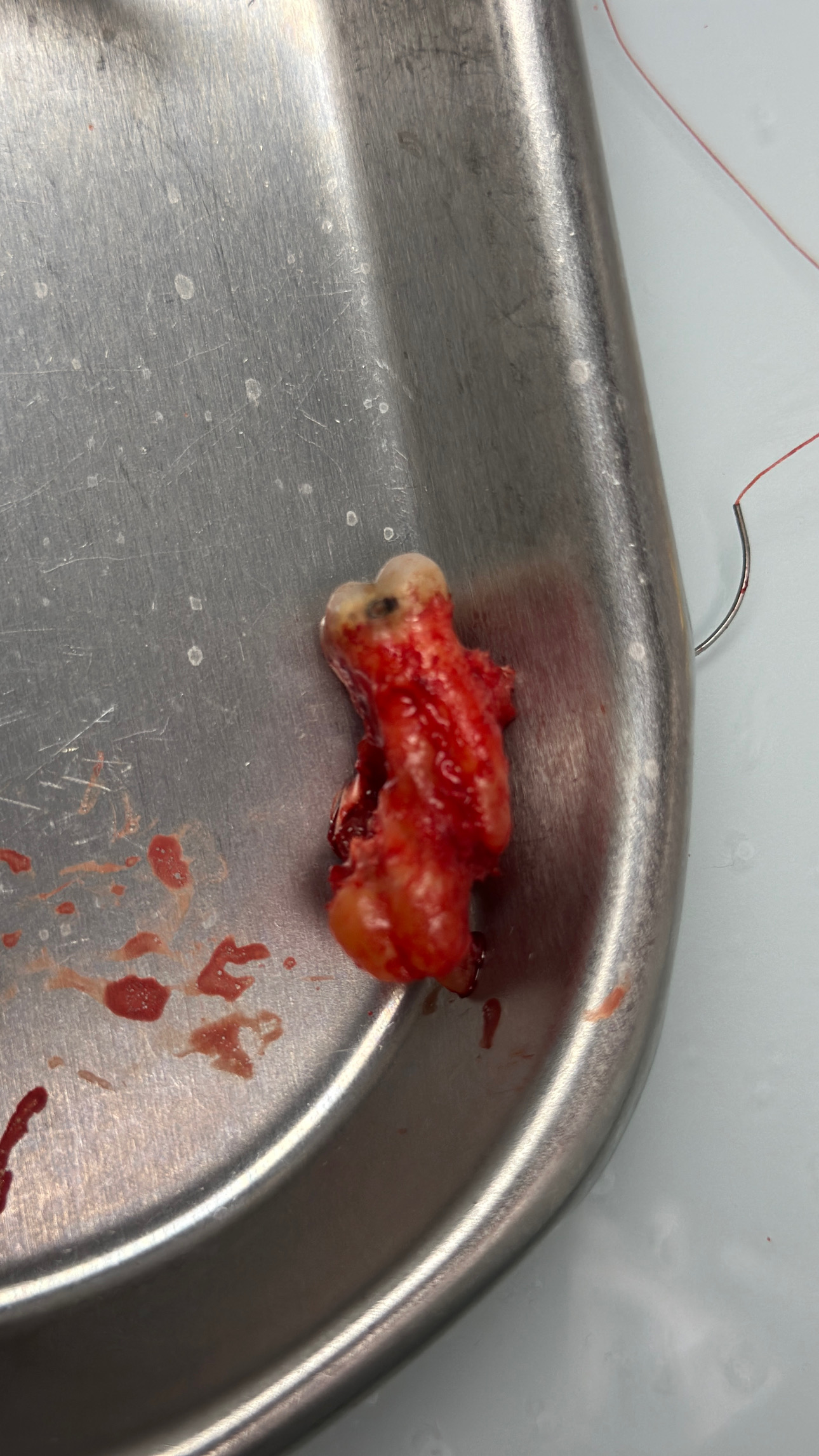 Showtime: Surgical Planning, Pitfalls, and Post-Op Wisdom