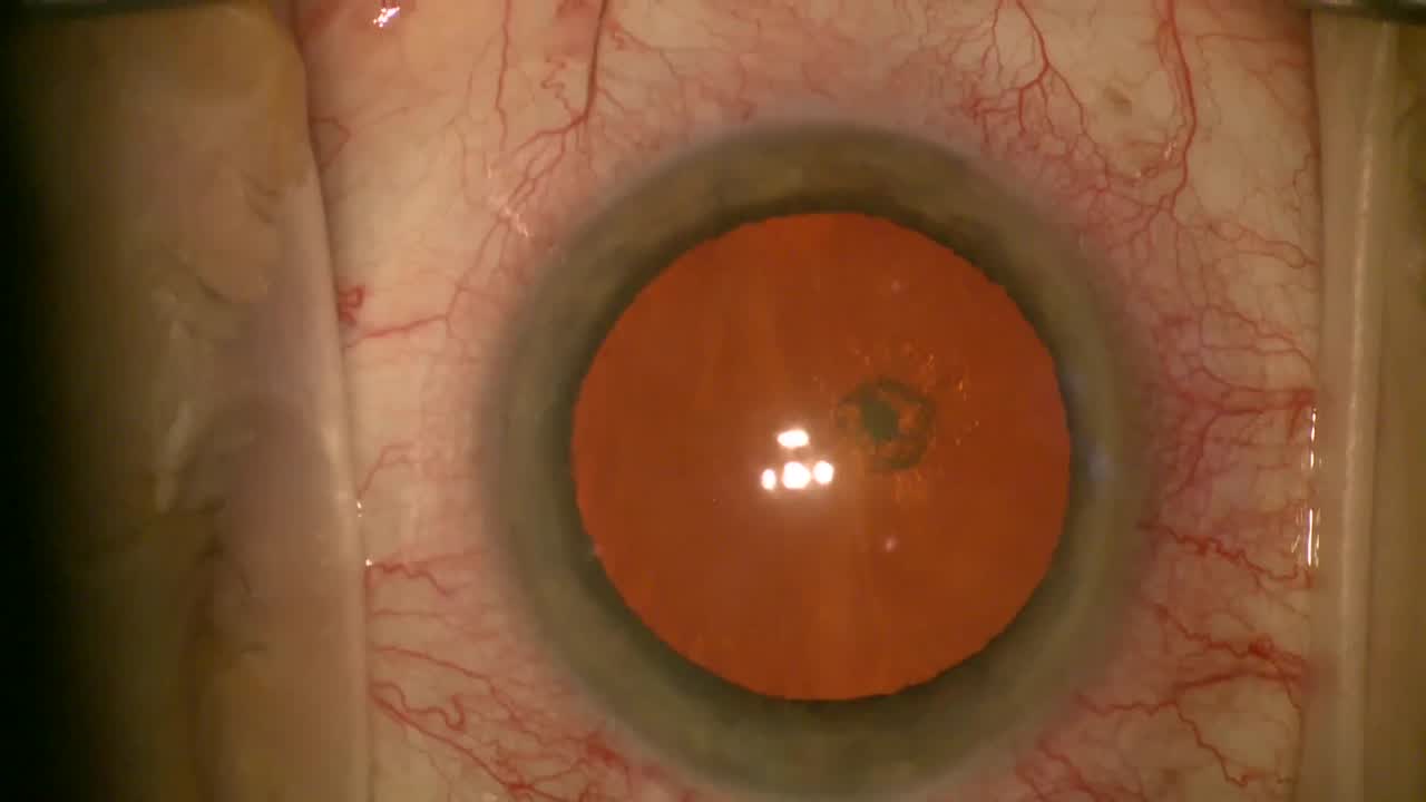 YAG Vitreolysis Complications Can be Severe Eyetube