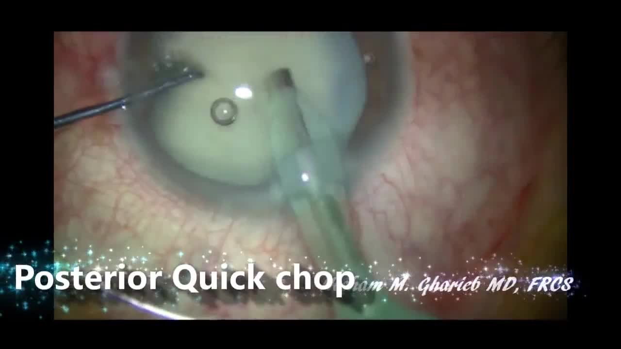 White Cataract The Safe Surgery Eyetube