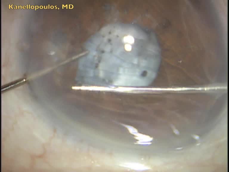 Sutureless PPV Residual Cataract Extraction Behind Implanted IOL Eyetube