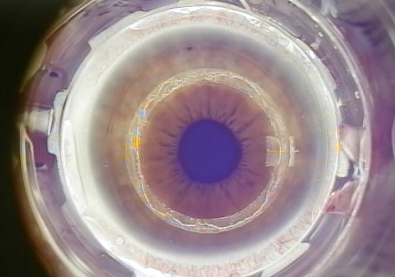 Combining Intacs With Epioff CXL Eyetube
