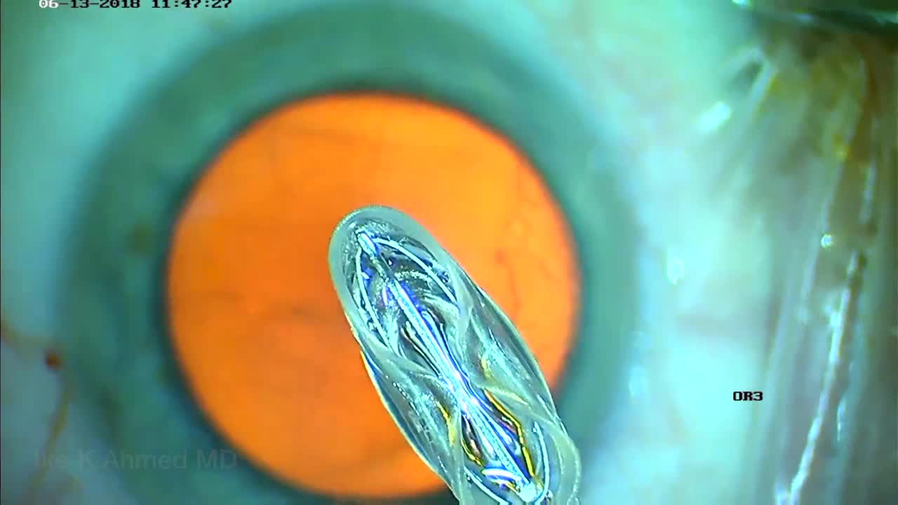 Zepto Precision Pulse Capsulotomy during Cataract Surgery Eyetube