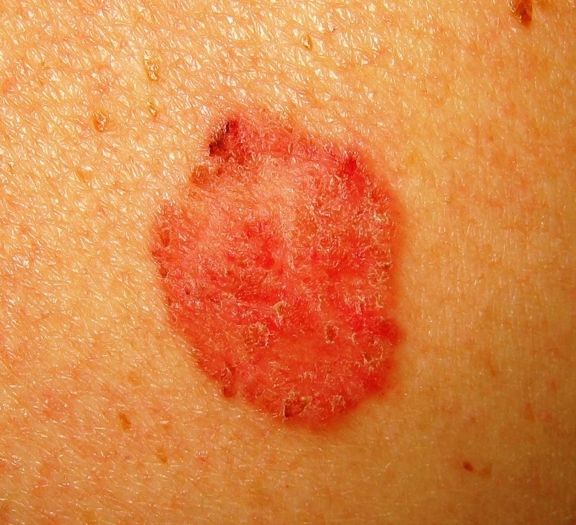 DESCRIBING SKIN LESIONS AND RASHES Flashcards in Alex Kinsky's ...