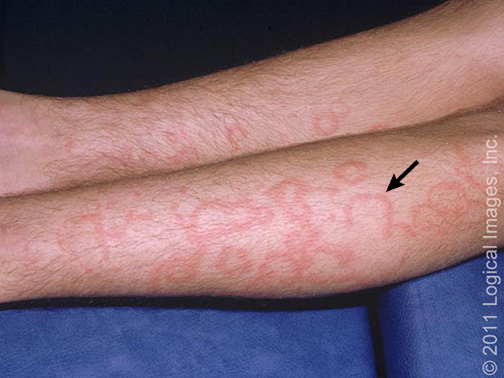 Arcuate Rash