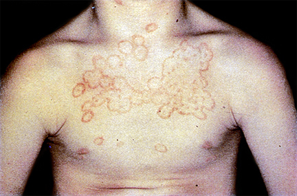 Arcuate Rash