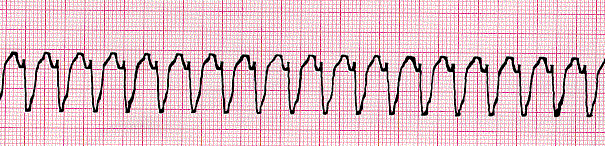 ALS and BLS Practice Questions Flashcards by Grace Yeung