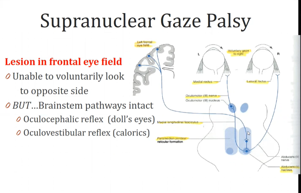 Paramedian Pontine Reticular Formation Lesion