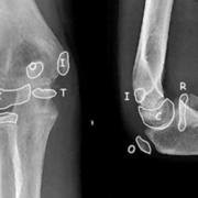 KB-peds