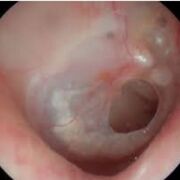 OMC Não Colesteatomatosa