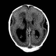 NEURO - Congênito/Genético