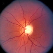RETINA
