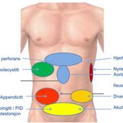 Akutt Abdomen