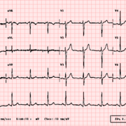ECGs