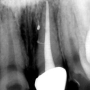 Endo (PR)