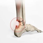 POD1074 Chx Reconstruction