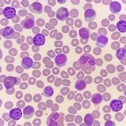 Internal Medicine- Hematology