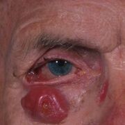 PLASTICA OCULAR E SISTEMA LACRIMAL