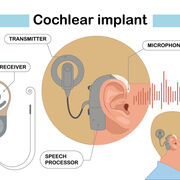 Implant cochléaire