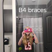 Braces