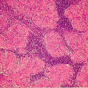 Aes 17- Morfo Infecto 2026.1