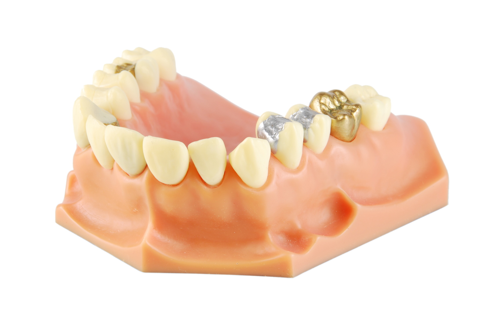 Dental model (with different treatments)