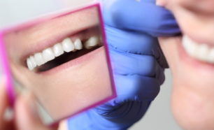 Dental Bridge
