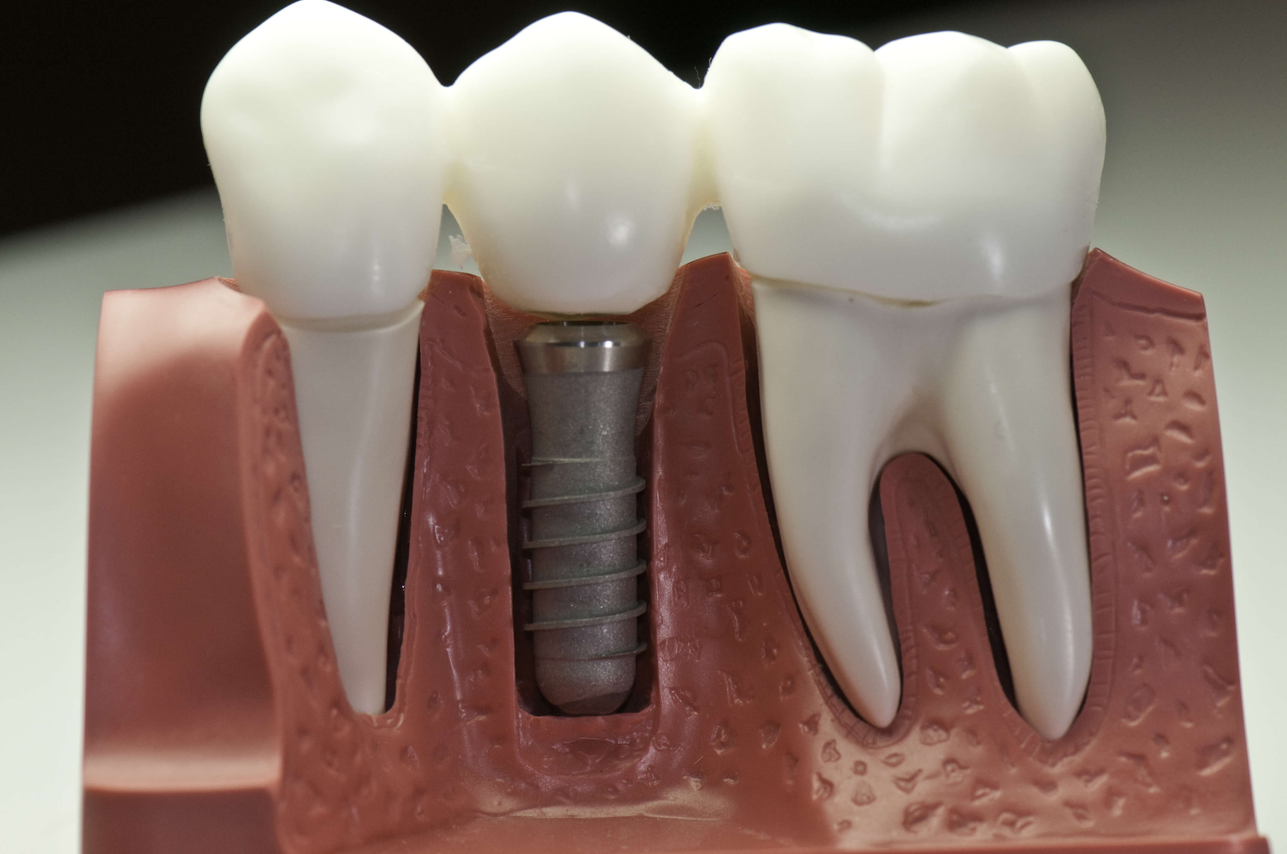 Everything You Need to Know About Dental Crowns