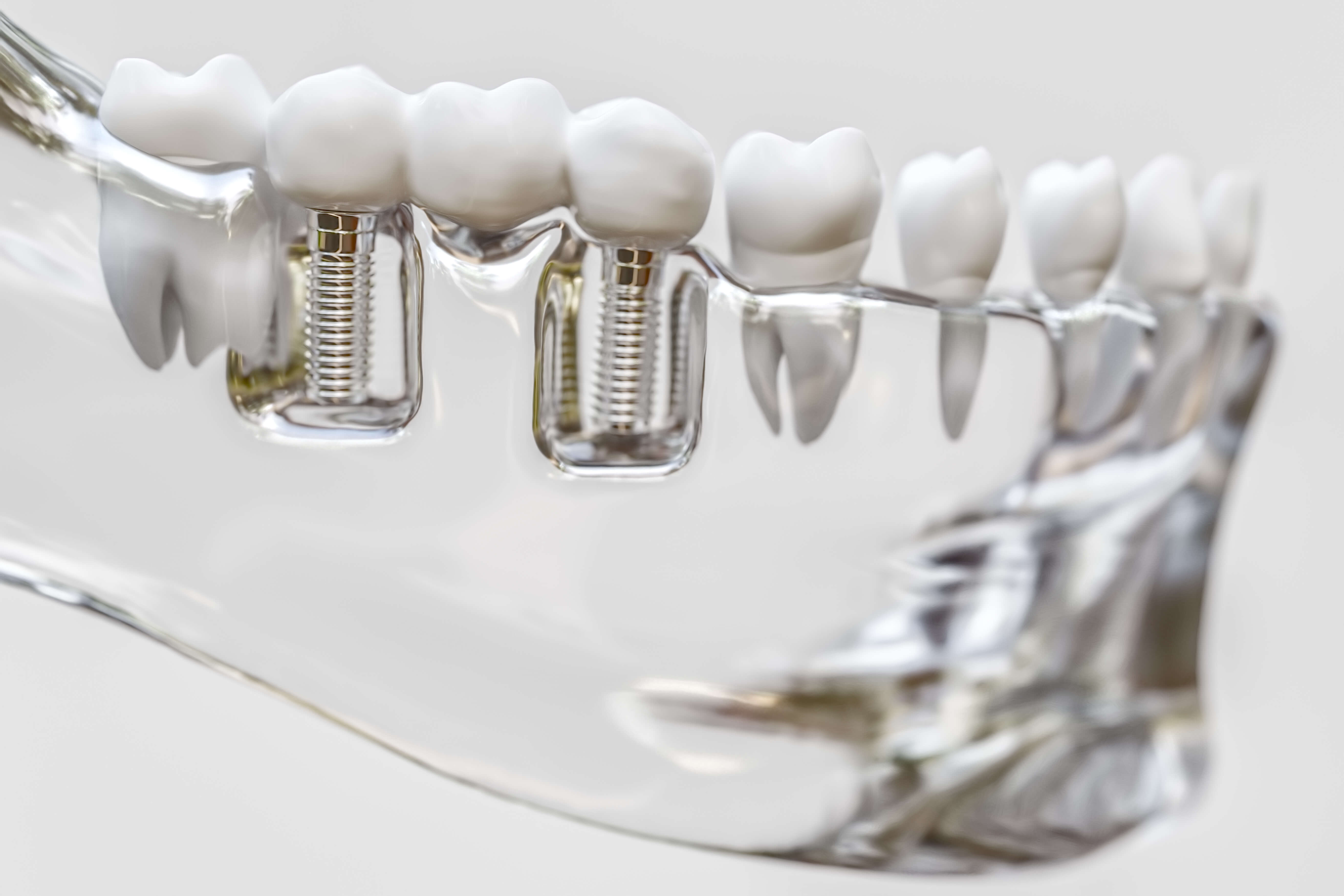 Dental Implants