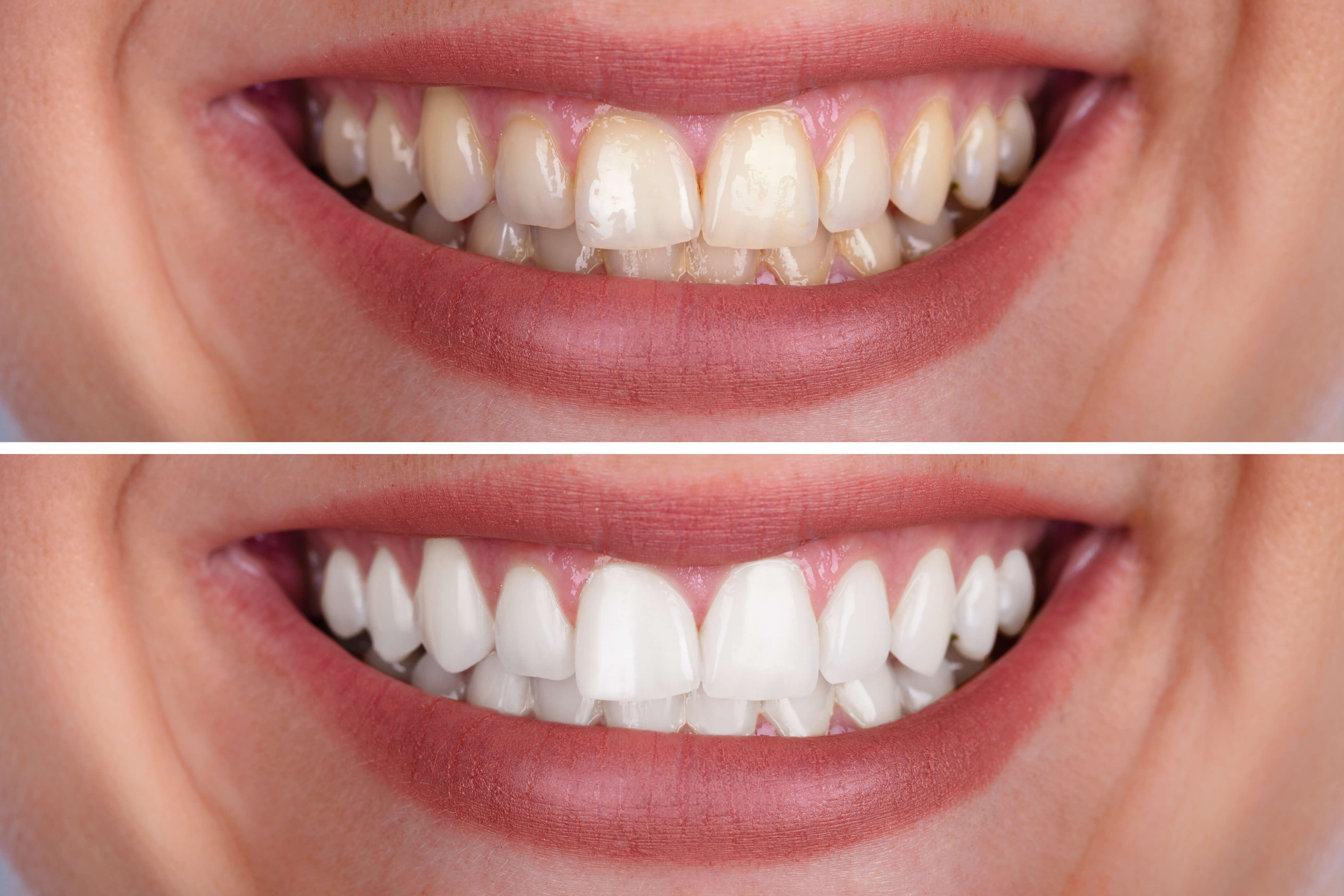 DIY Tooth Whitening