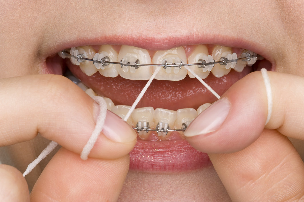 The Best Way to Floss With Braces Reddick Orthodontics